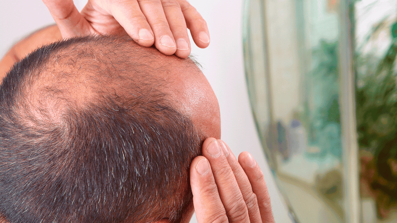 ¿Cómo evitar la caída del cabello en hombres: causas y tratamiento?