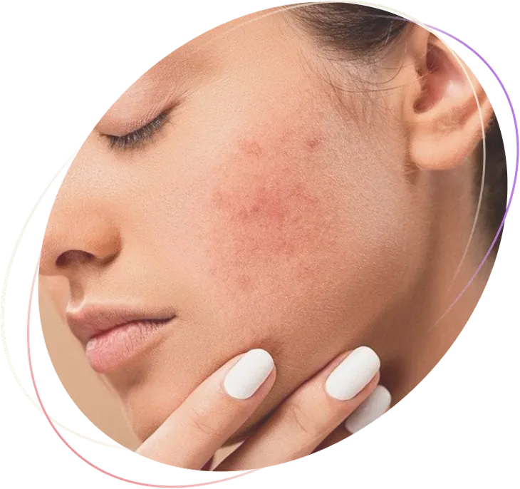 Tratamiento facial de acné