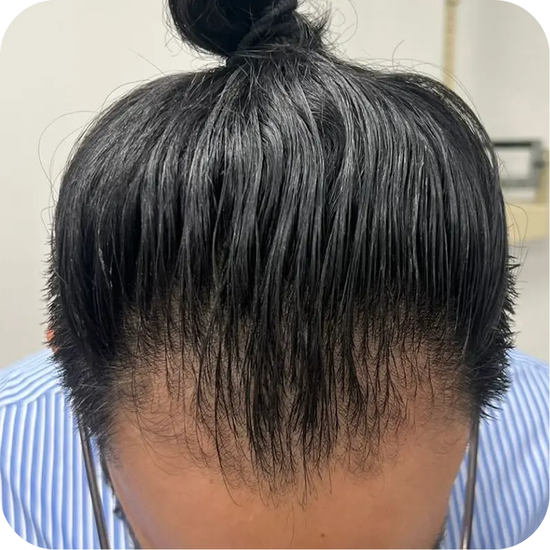 Tratamiento facial de alopecia